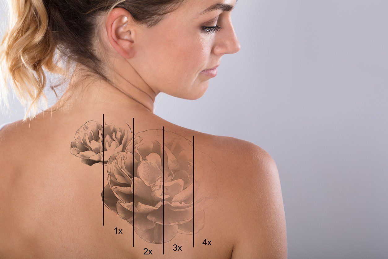 Non-Invasive Magnetic Tattoo Removal Technique by Linda Paradis