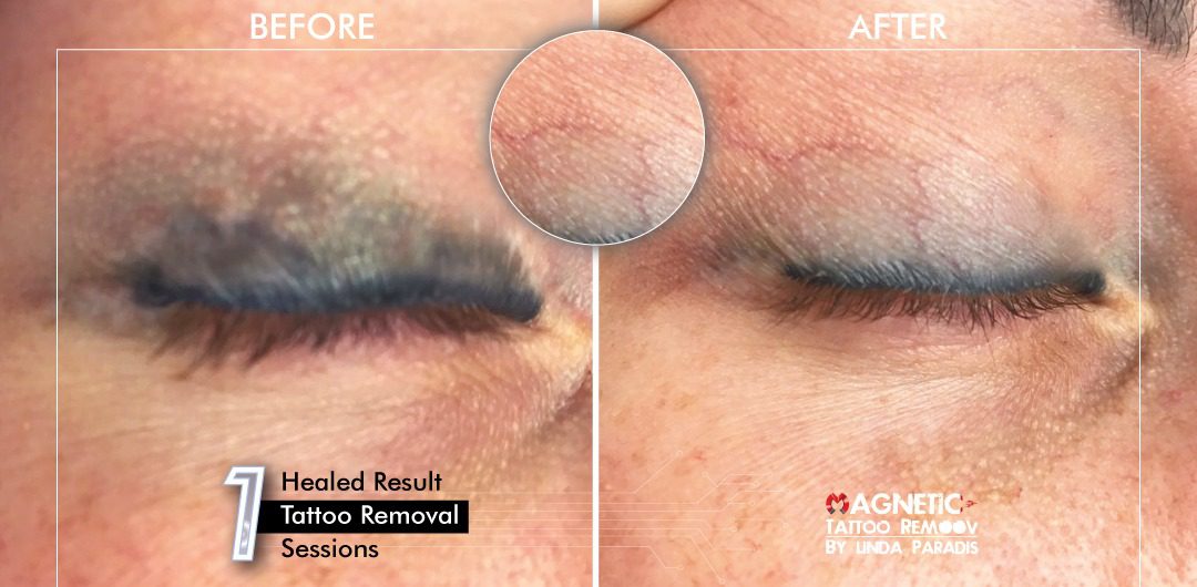 Non-Invasive Magnetic Tattoo Removal Technique by Linda Paradis
