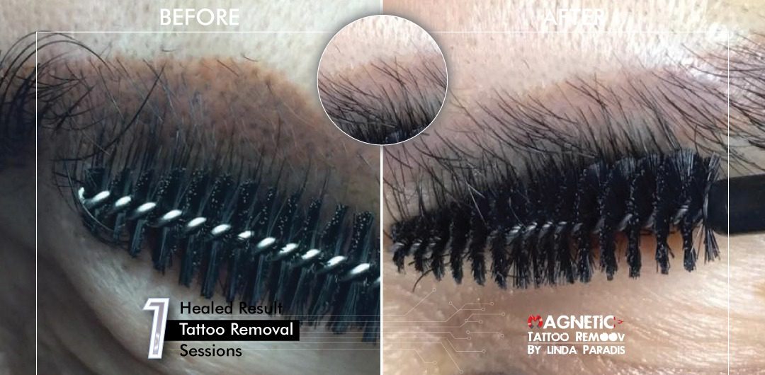 Non-Invasive Magnetic Tattoo Removal Technique by Linda Paradis