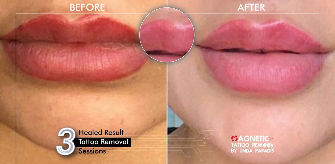 Non-Invasive Magnetic Tattoo Removal Technique by Linda Paradis