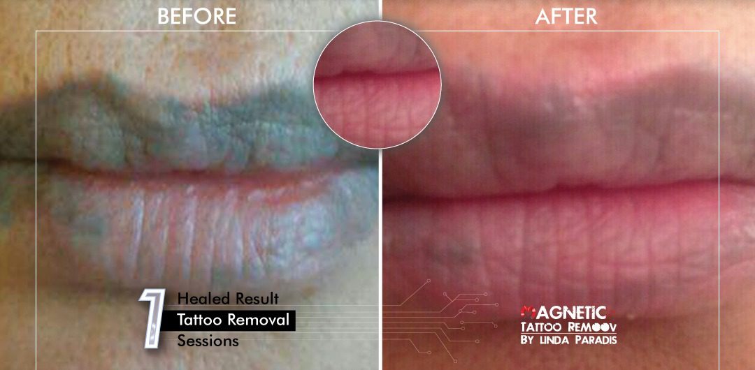 Non-Invasive Magnetic Tattoo Removal Technique by Linda Paradis