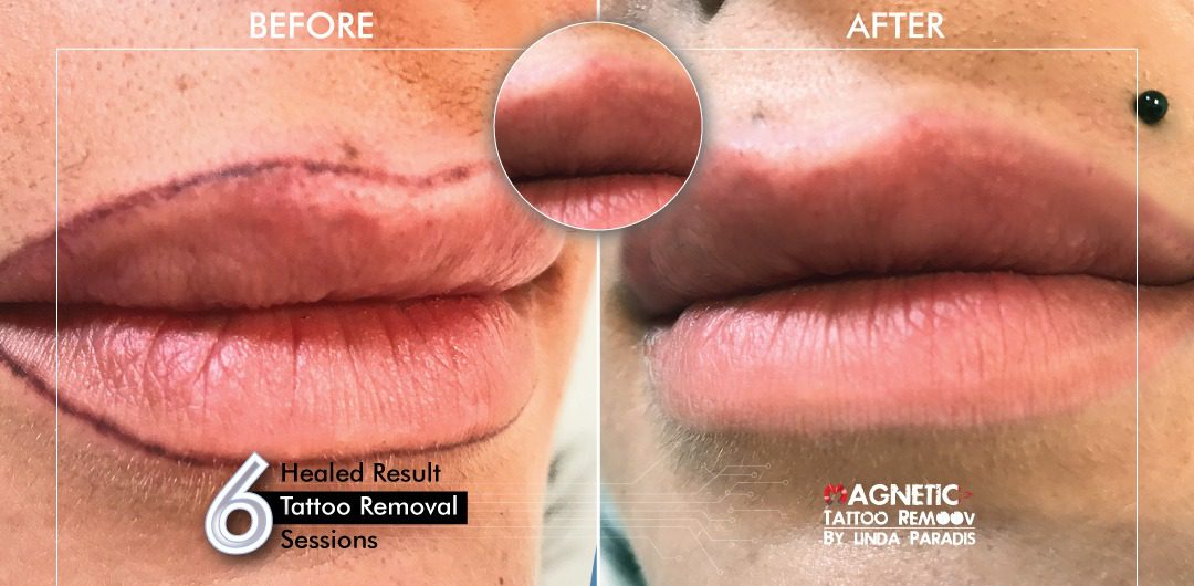Non-Invasive Magnetic Tattoo Removal Technique by Linda Paradis
