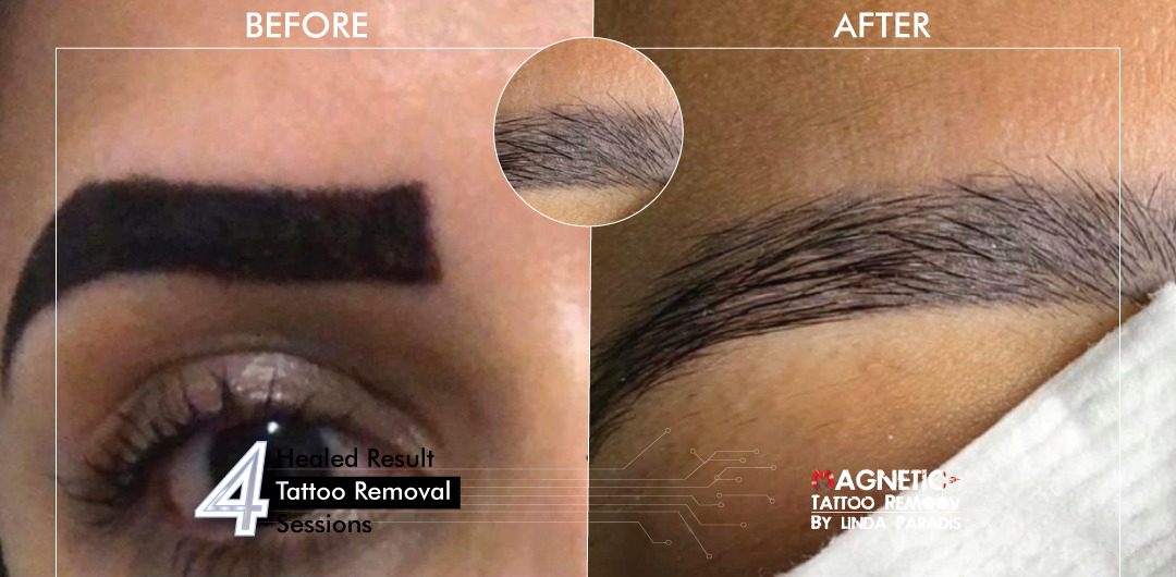 Non-Invasive Magnetic Tattoo Removal Technique by Linda Paradis
