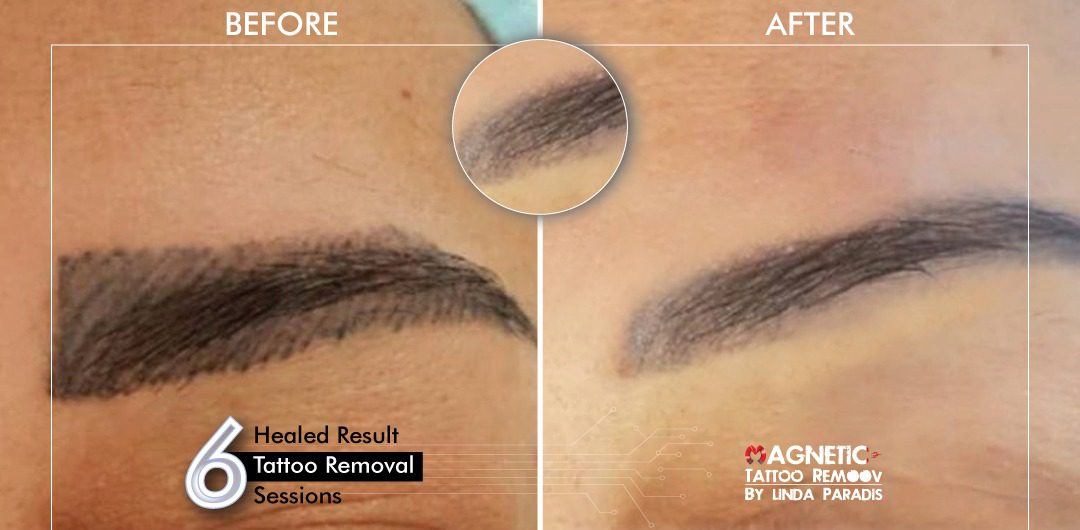 Non-Invasive Magnetic Tattoo Removal Technique by Linda Paradis