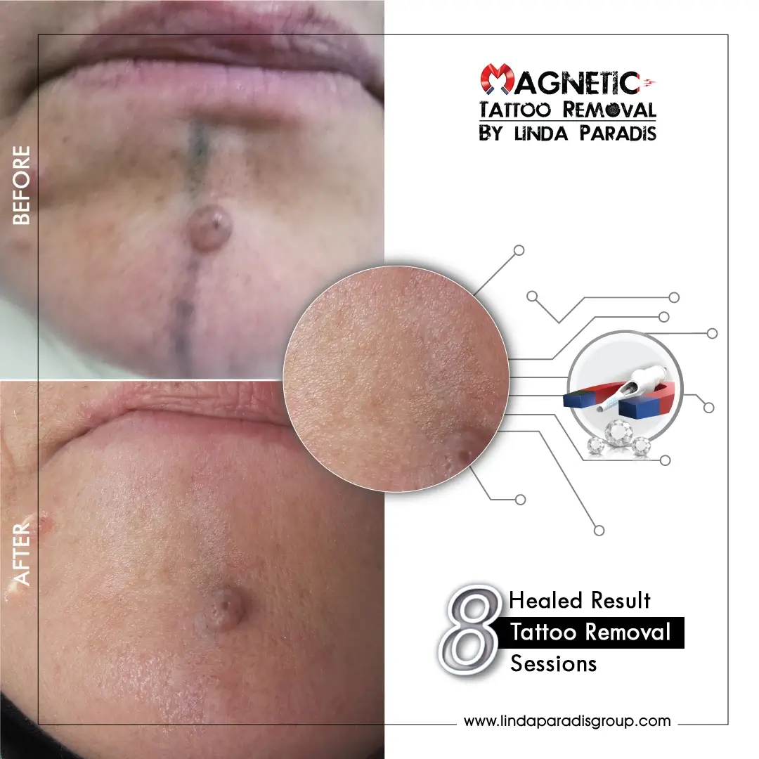 Ethnic body tattoo removal before and after – Magnetic Tattoo Removal® non-invasive technique