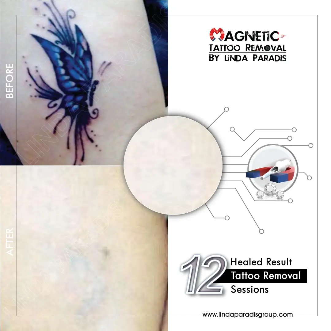 Body tattoo before and after removal – non-laser Magnetic Tattoo Removal® by Linda Paradis Group