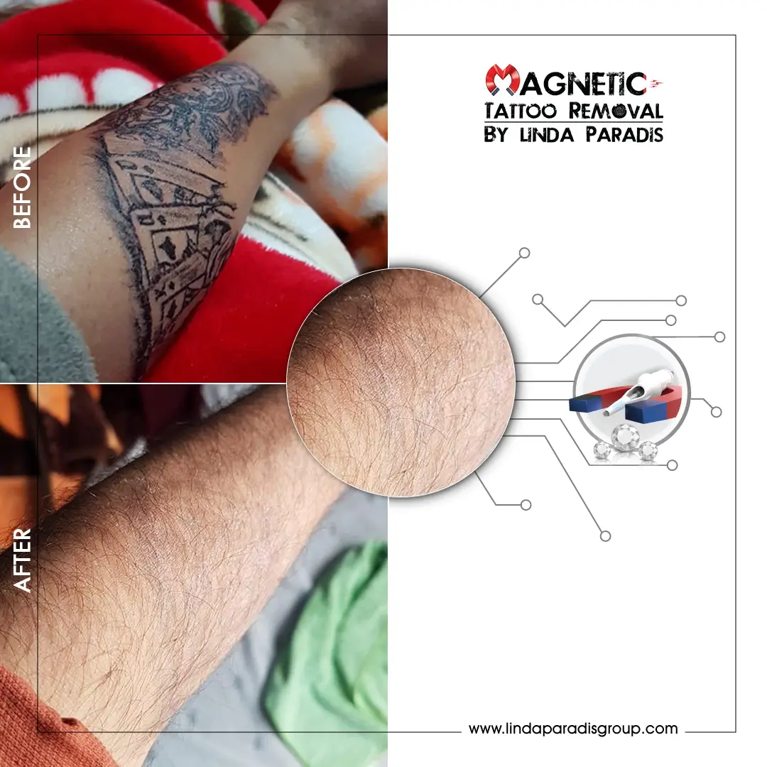 Emergency tattoo removal before and after – Magnetic Tattoo Removal® delivers results without scarring or downtime