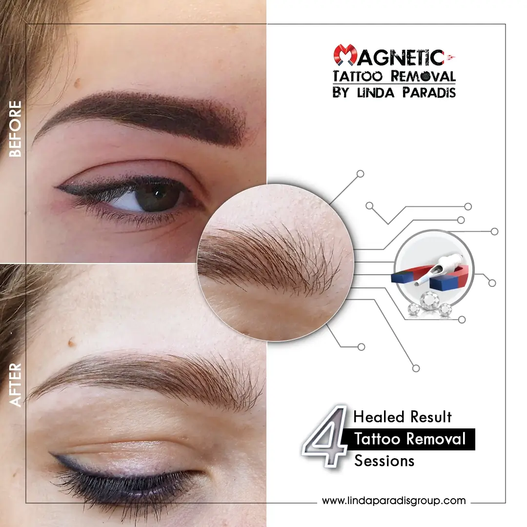 Microblading removal before and after using Magnetic Tattoo Removal® — non-invasive, scar-free eyebrow tattoo removal