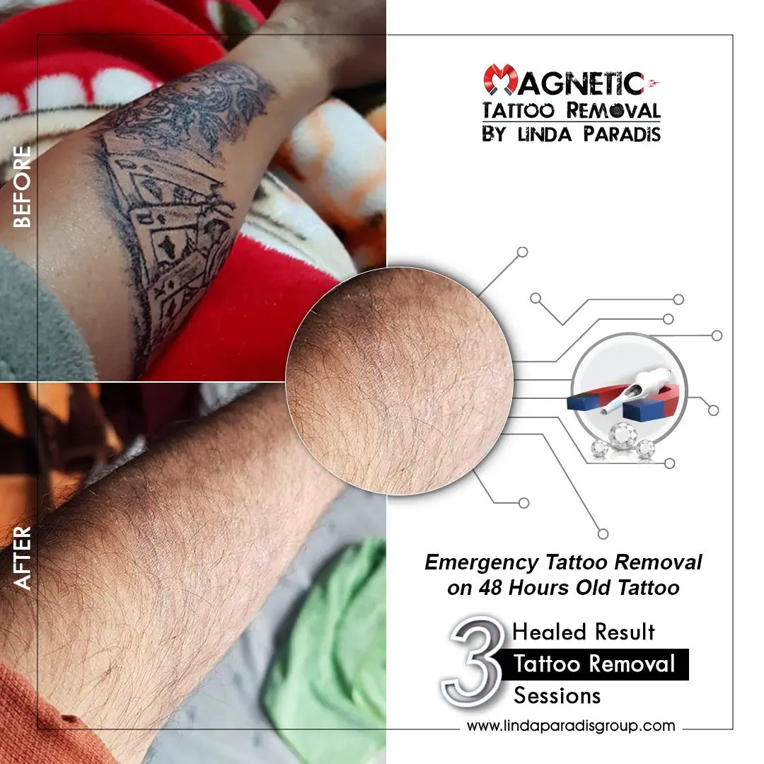 Body emergency tattoo removal before and after 3, Magnetic Tattoo Removal