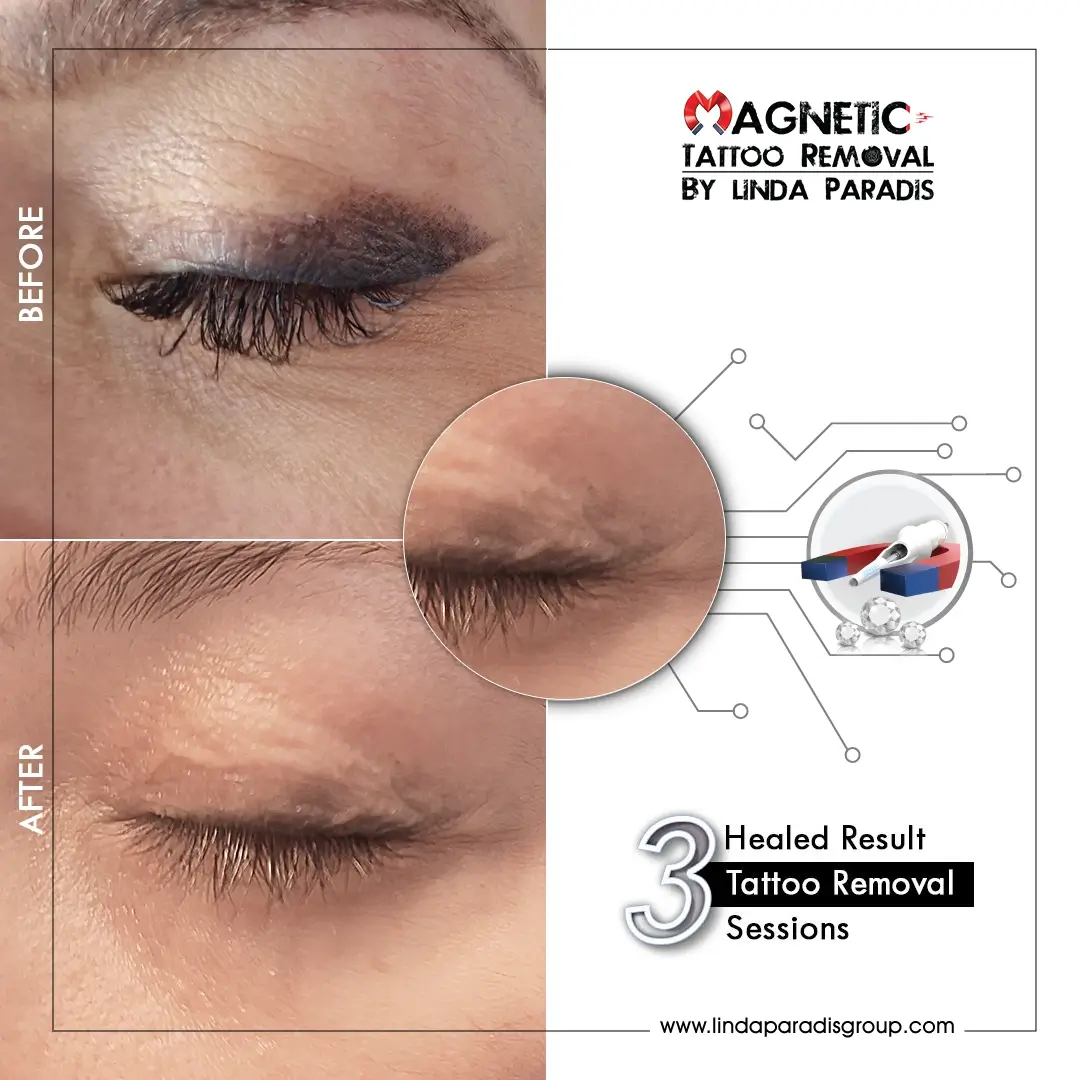 Eyeliner Removal Before and After