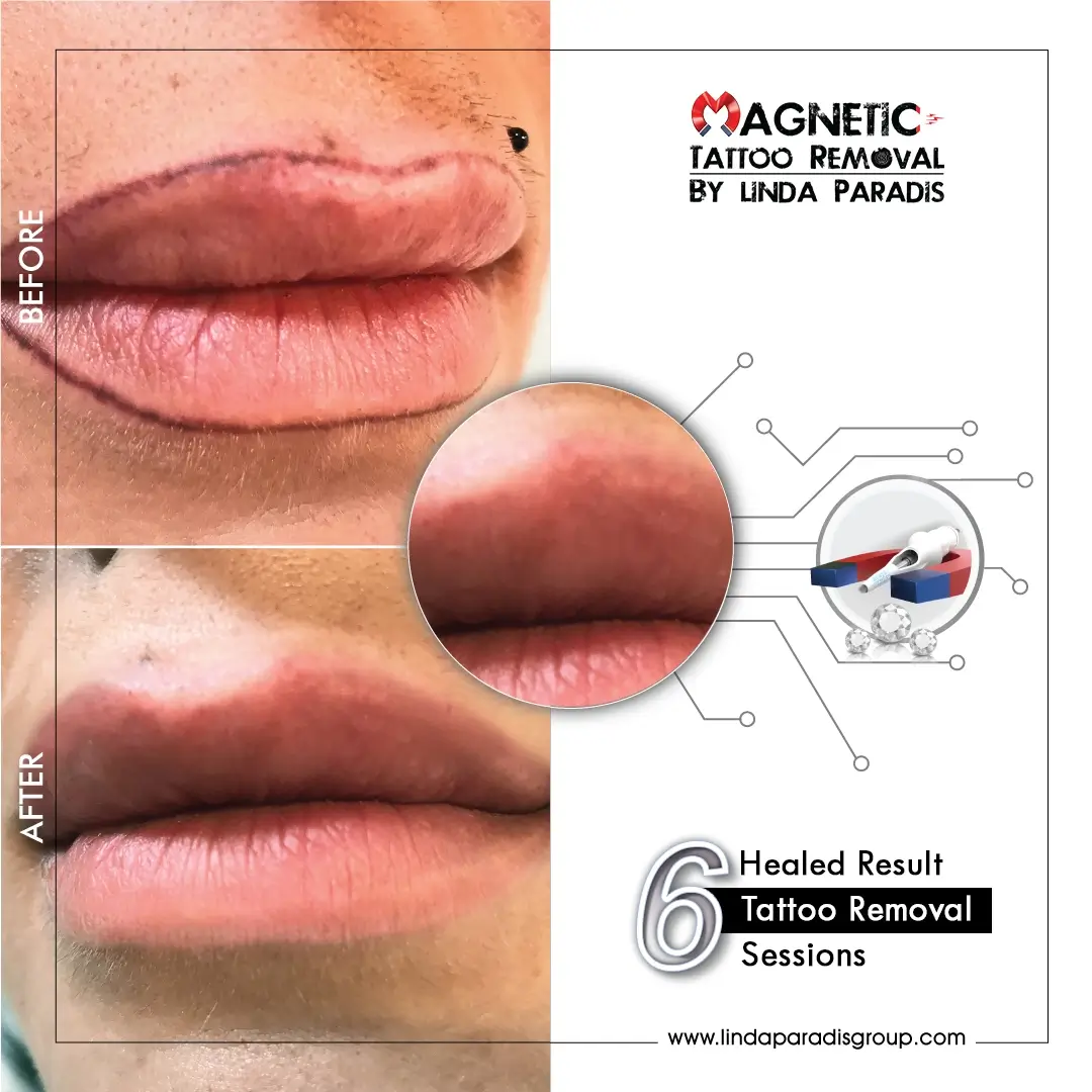 Lips Contour Tattoo Removal Before and After 2 (1)