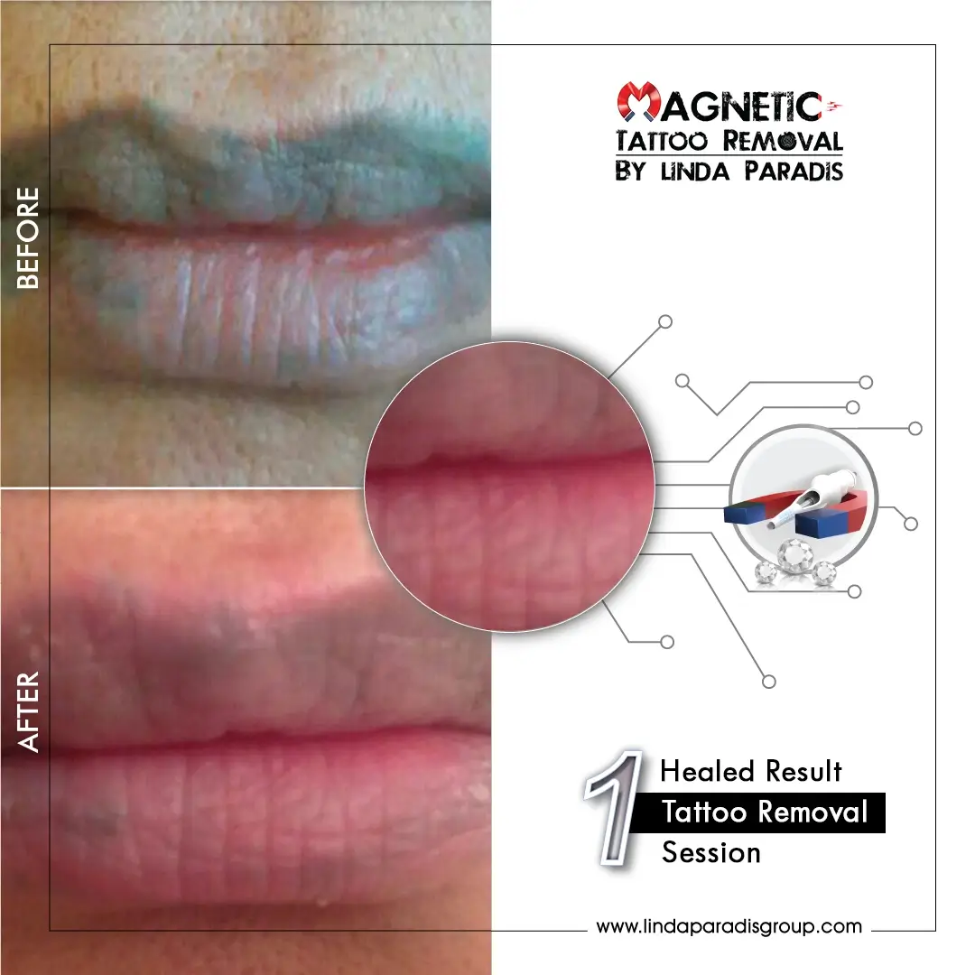 Non-Invasive Magnetic Tattoo Removal for Microblading and Permanent Makeup Removal — Live Online Hands-On Training - Image 4