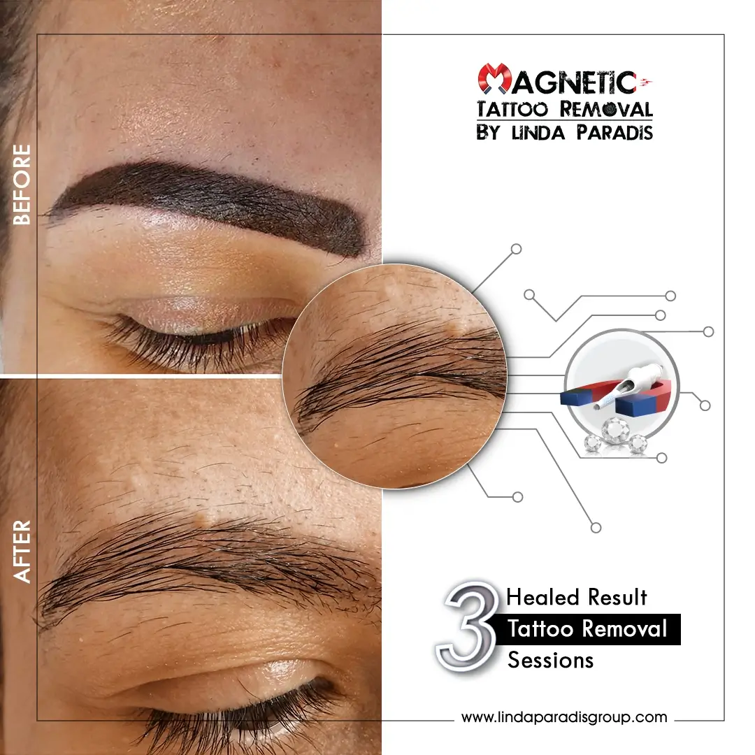 Microblading Removal Before and After 2