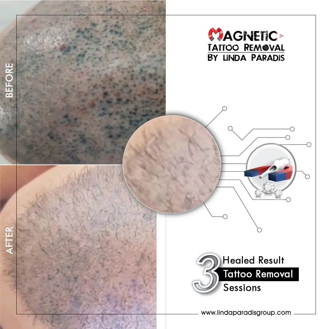 Scalp Tattoo Removal Before and After (1)