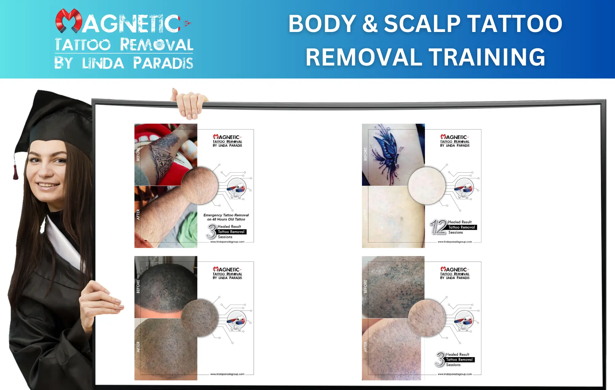 Magnetic Tattoo Removal Course 2 for Removing Body and Scalp Tattoos