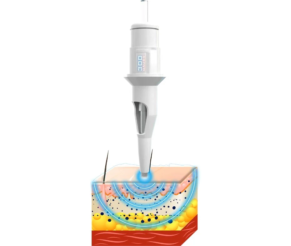 Non-Invasive Cosmetics needles 132 (Used for Icy Lips) - Image 3