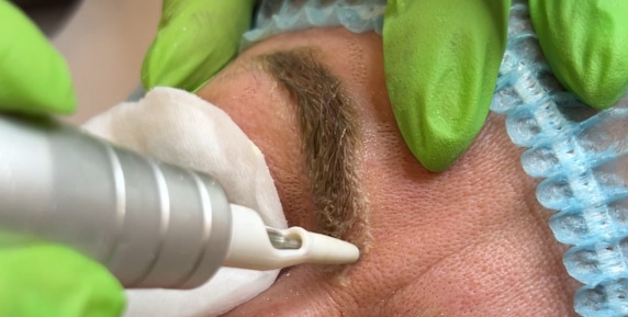Non-invasive magnetic needles working on the skin surface during non-laser tattoo removal